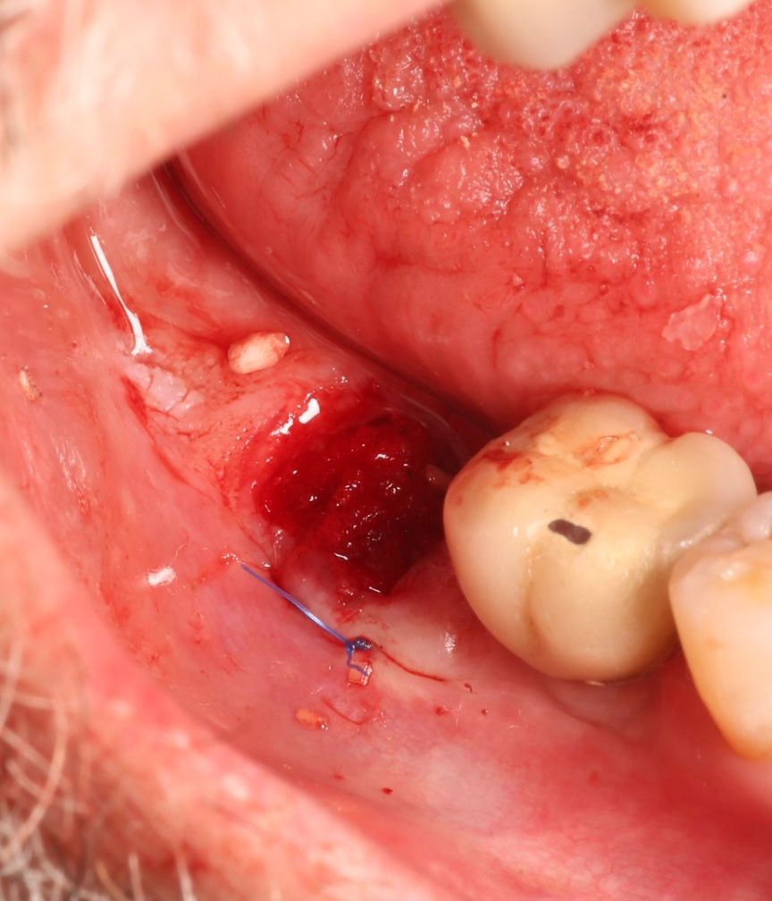Cirugía Maxilofacial e Injertos
