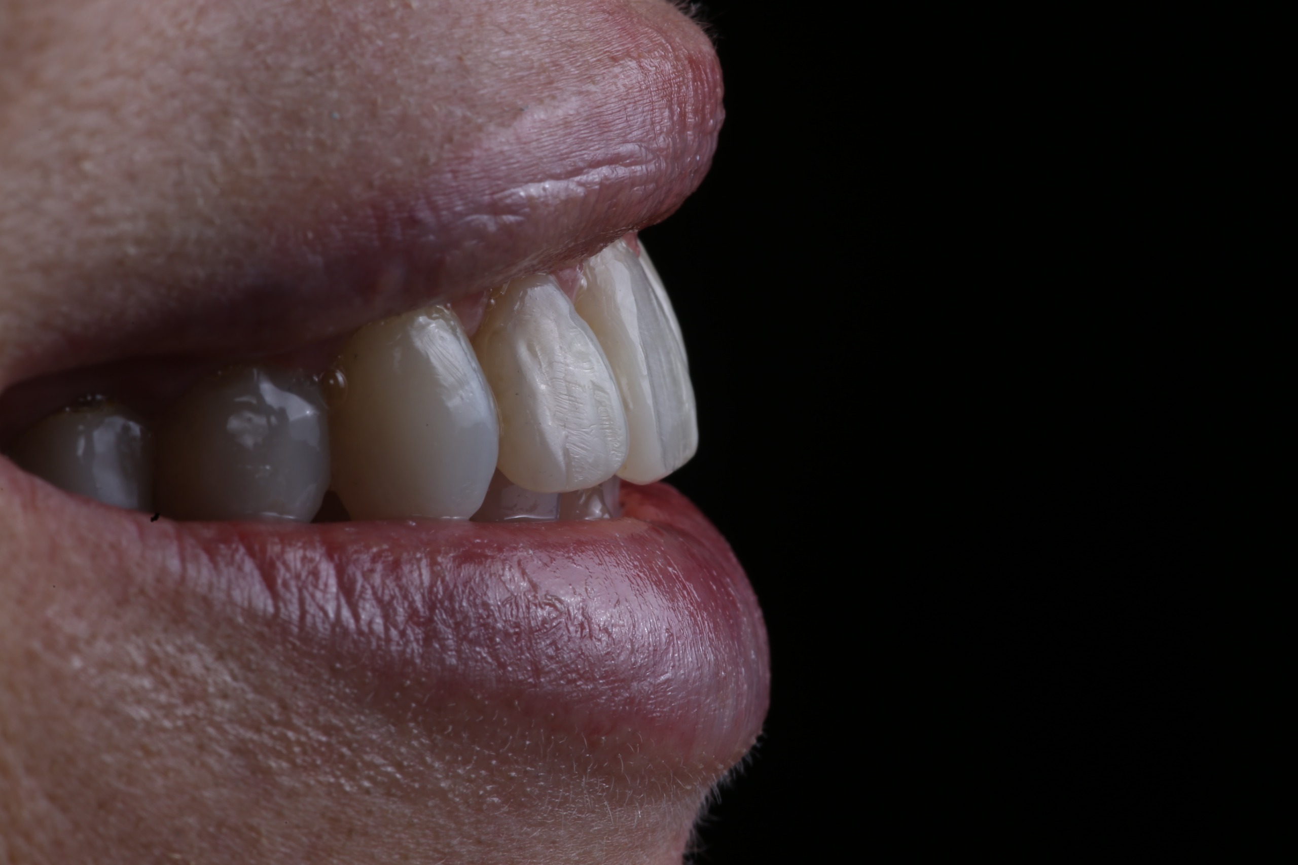 Antes y después - Diseño estético dental y carillas